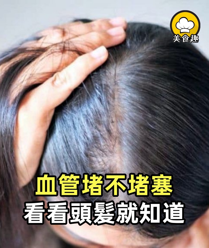 血管堵不堵塞,看看頭髮就知道,一看一個准,為自己收藏!