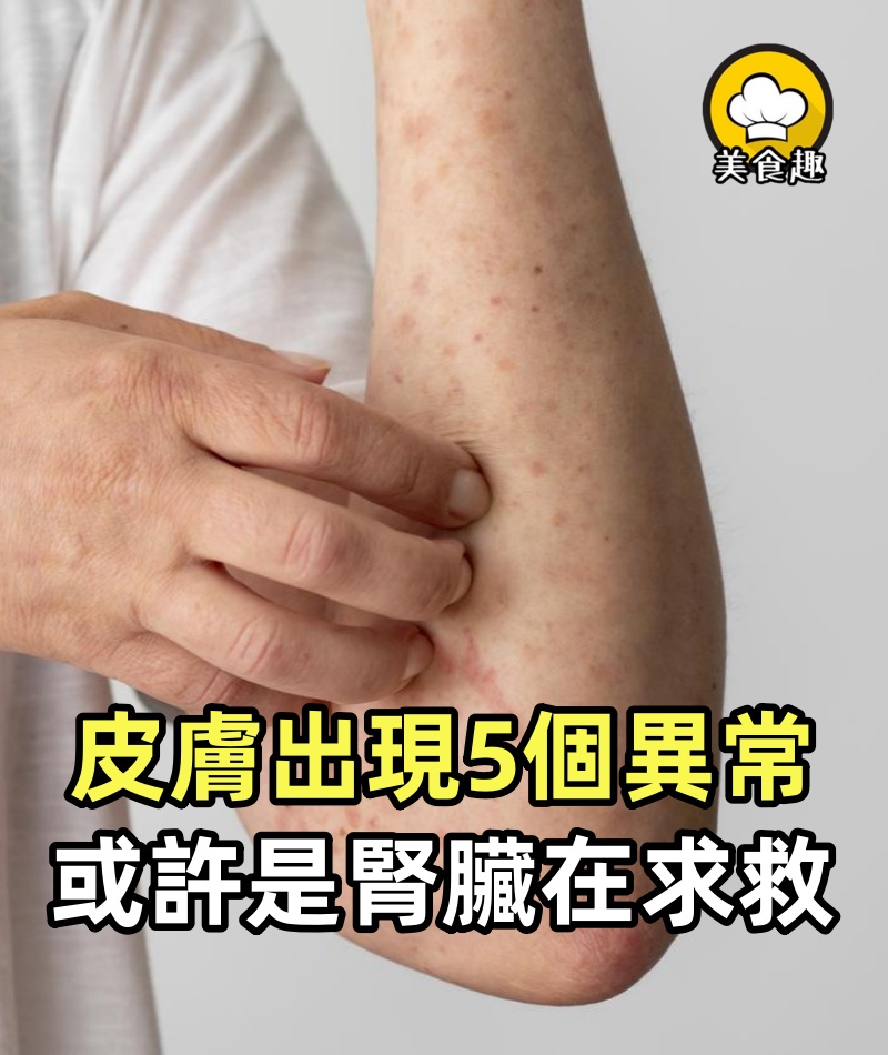 不是皮膚病而是腎衰竭報警?皮膚出現5個異常,或許是腎臟在求救